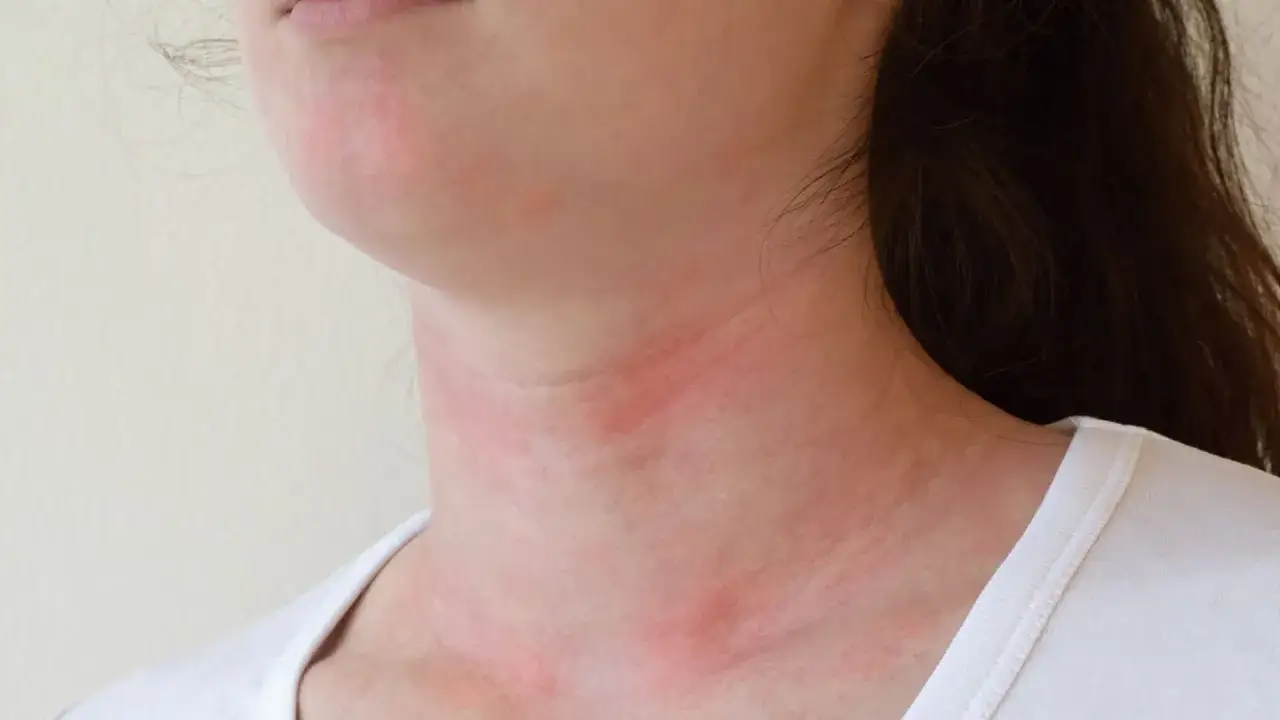 Uczulenie na curry objawy - jak je rozpoznać i uniknąć reakcji alergicznych