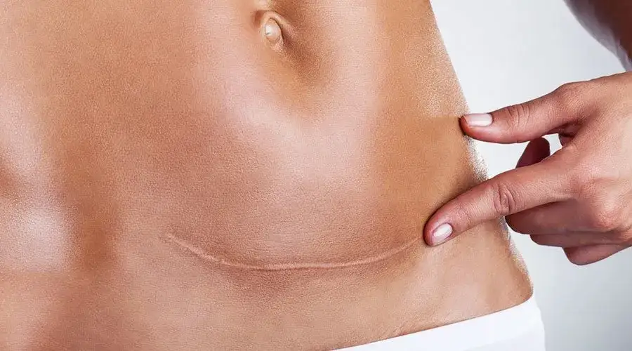 Fizjoterapia po CC: Kiedy zacząć i dlaczego to klucz do zdrowia?