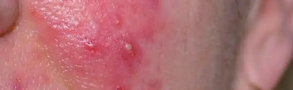 Zjawisko łojotoku: przyczyny, objawy i skuteczne metody leczenia