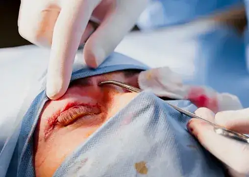 Blefaroplastyka górnych vs dolnych powiek – czym się różnią i kiedy je łączyć?