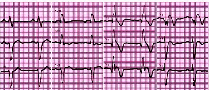 Objawy zaburzeń przewodnictwa śródkomorowego – co musisz wiedzieć o tym stanie serca