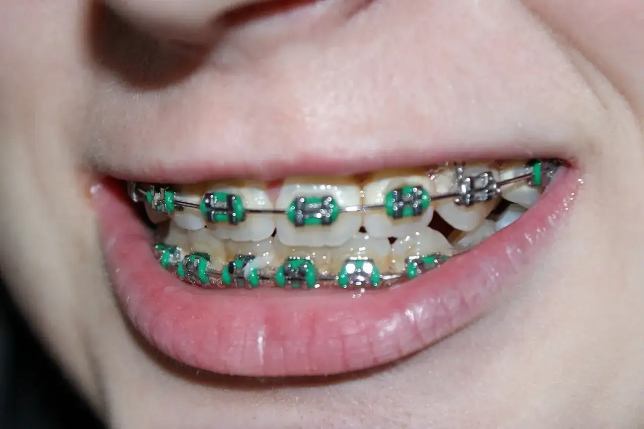 Jak długo trzeba nosić aparat na zęby? Wszystko o czasie leczenia ortodontycznego