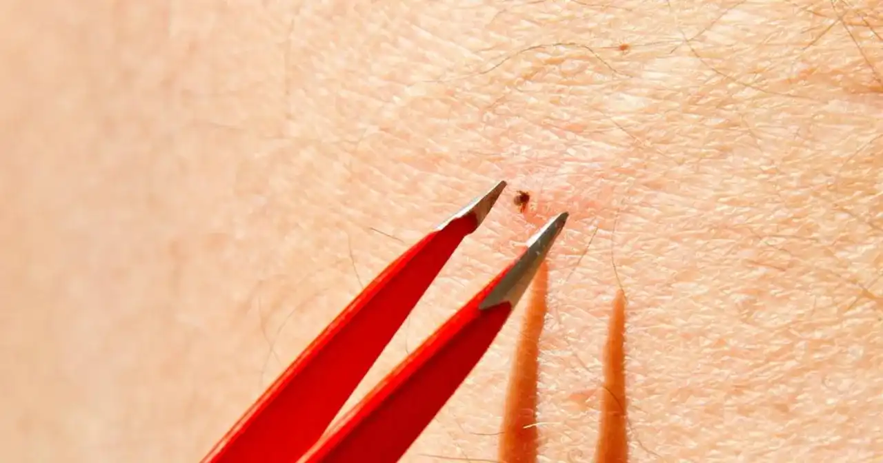 Mały kleszcz w skórze - jak usunąć nimfę i co dalej?