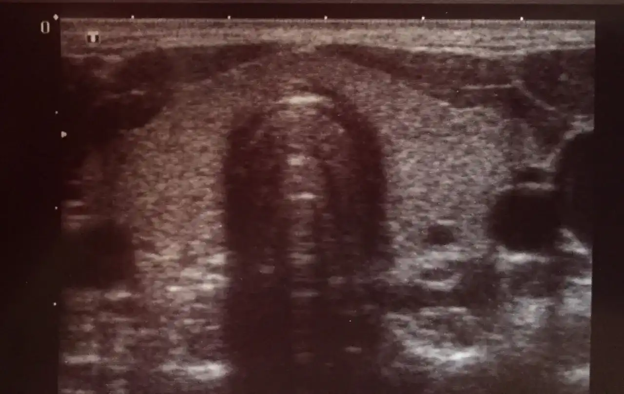 Wymiary tarczycy USG - normy i co oznaczają Twoje wyniki?