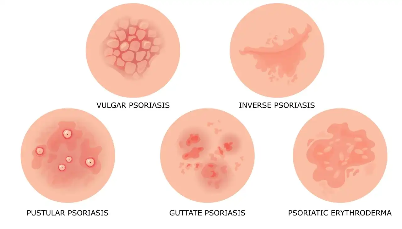 Pierwsze objawy łuszczycy - jak rozpoznać i co robić?