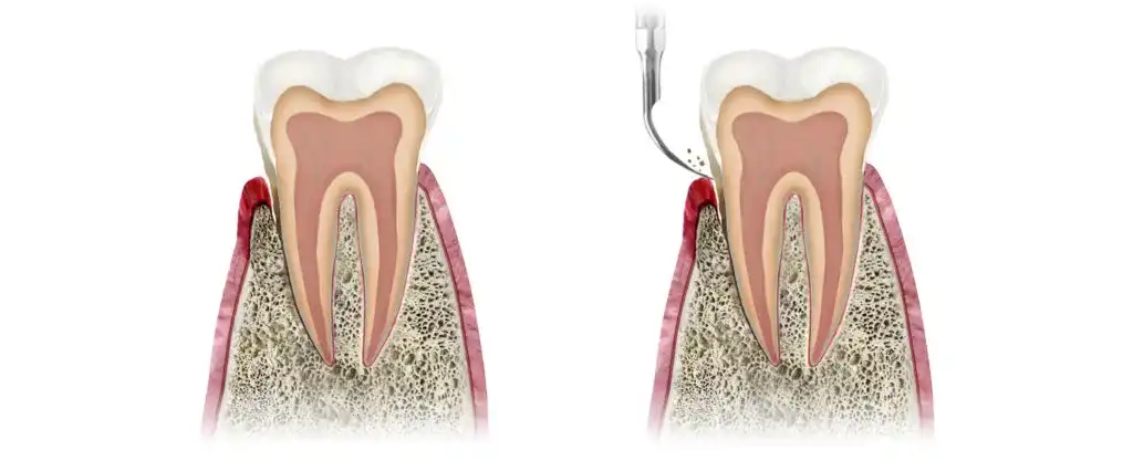 Jak skutecznie wyciągnąć ropę z dziąsła i uniknąć bólu