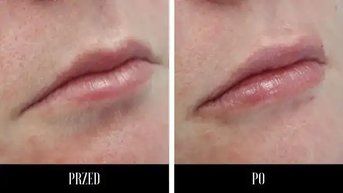 Powiększanie ust Lublin - gdzie najlepiej i co warto wiedzieć?