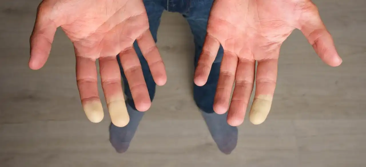 Tarczyca a objaw Raynauda - co musisz wiedzieć o powiązaniach?