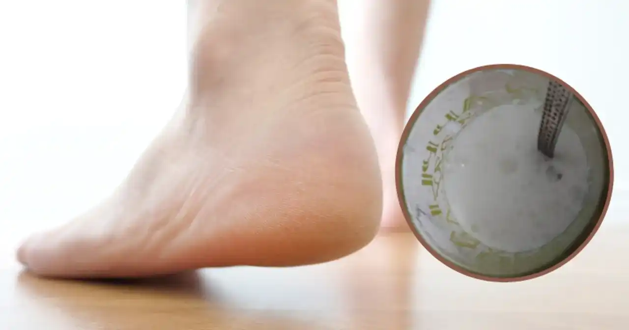 Czosnek na ostrogi piętowe: Czy warto? Sprawdź przepis i ryzyko