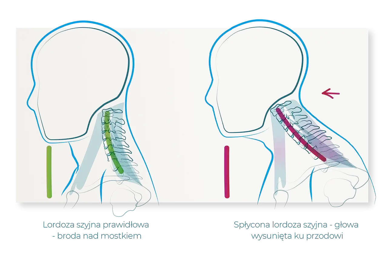 Zniesiona lordoza szyjna - jak skutecznie leczyć i zapobiegać?