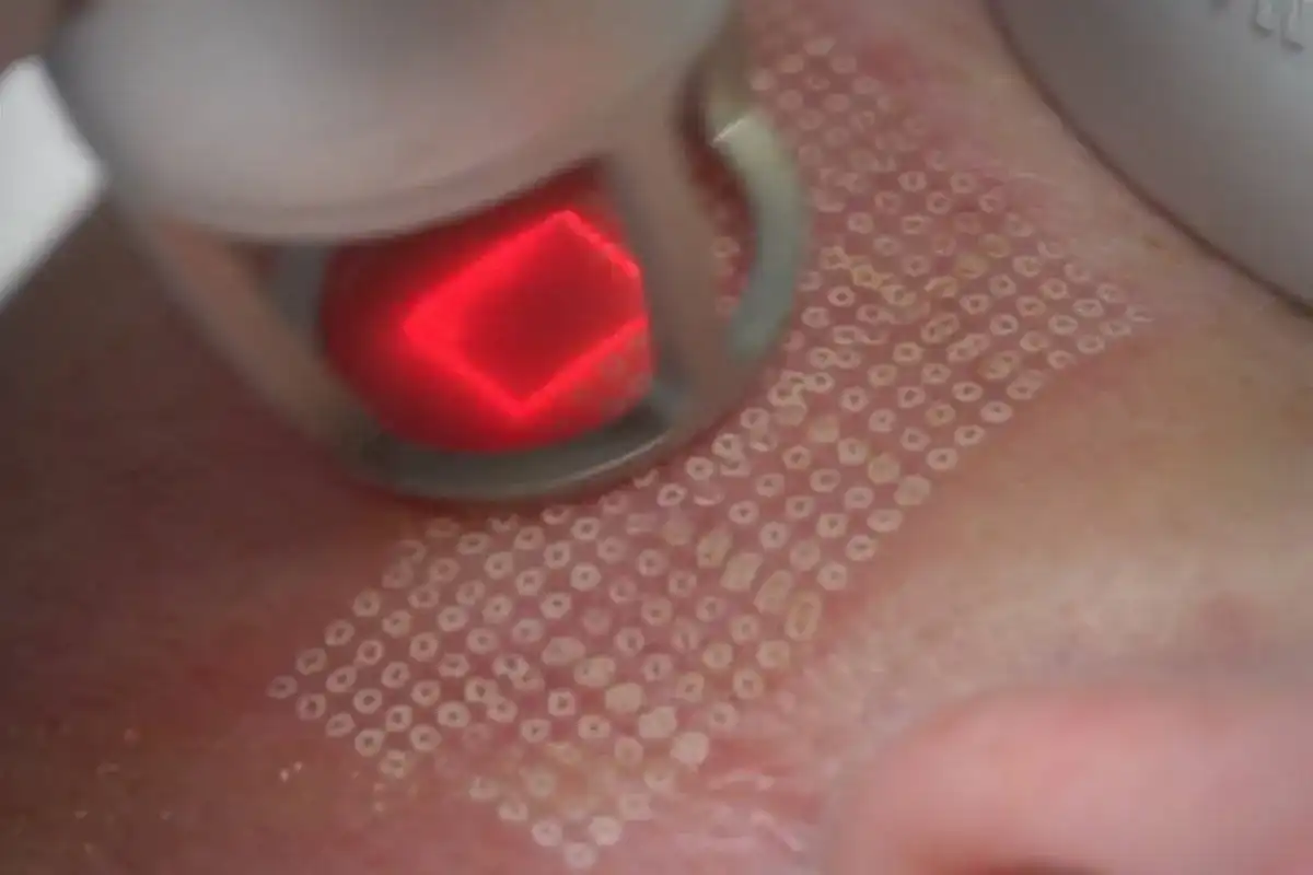 Jak wygląda zabieg laser frakcyjny? Efekty i co warto wiedzieć