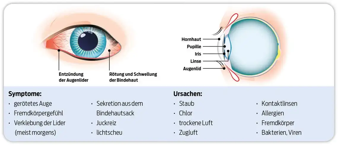 Wirksame Medikamente gegen Bindehautentzündung: Tipps und Empfehlungen
