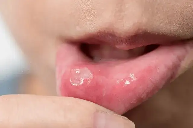 Objawy HPV w jamie ustnej - co możesz przegapić i jak reagować