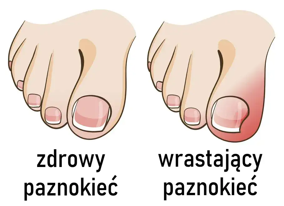Jak wyciąć wrastający paznokieć i uniknąć bólu oraz powikłań