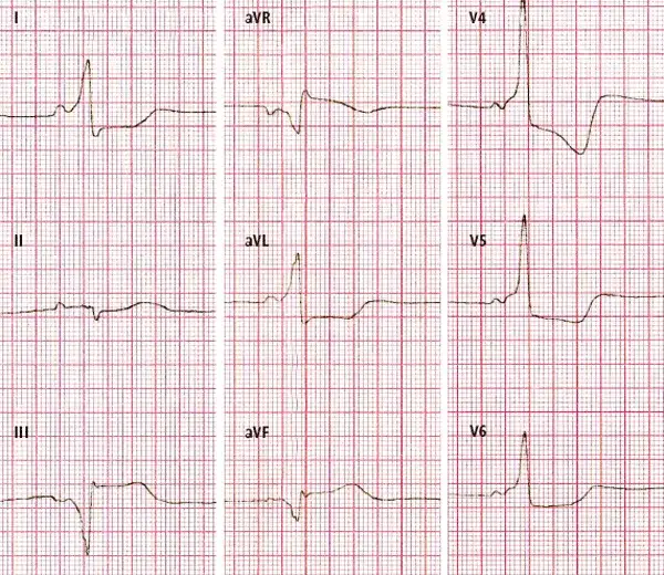 Objawy zaburzeń repolaryzacji EKG: Kiedy się martwić, a kiedy nie?