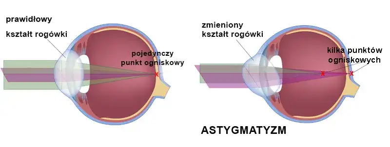 Czy wada wzroku to choroba? Poznaj prawdę o problemach ze wzrokiem