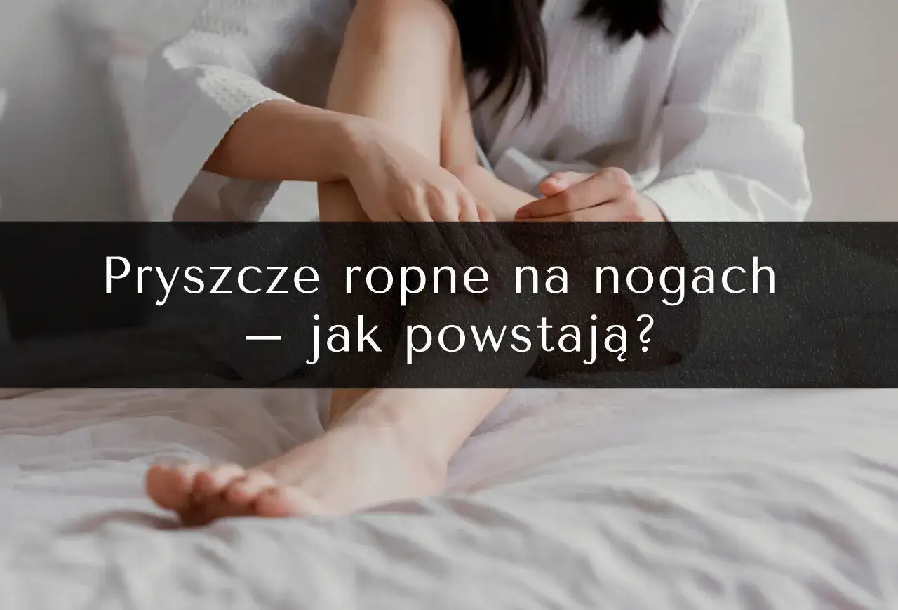 Pryszcze na nogach: przyczyny, skuteczne metody leczenia i profilaktyka