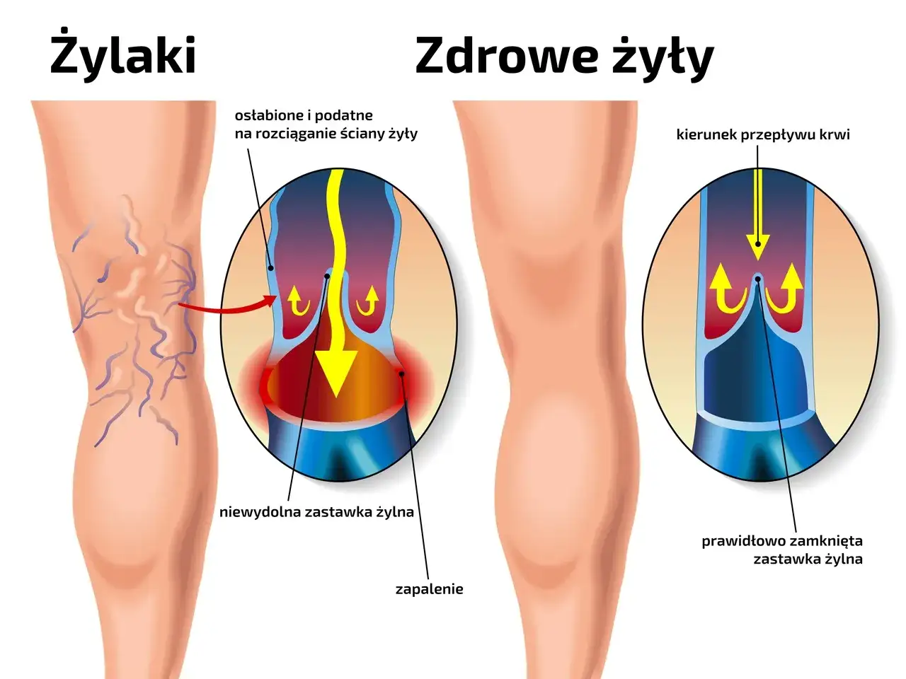 Ilustracja porównująca żylaki z zdrowymi żyłami, pokazująca nieprawidłowe działanie zastawek żylnych.