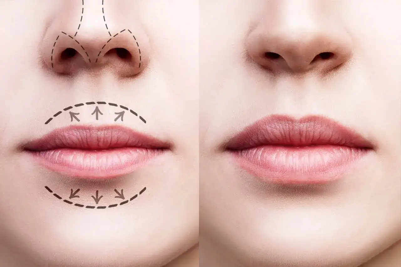 Comparativa de labios antes y después de ácido hialurónico. Muestra diferentes tipos de labios y cómo el relleno mejora su volumen y forma.
