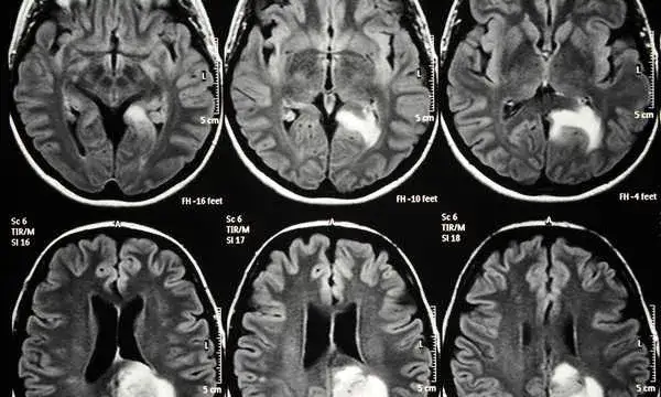 Czy rezonans magnetyczny wykryje chorobę psychiczną? Oto prawda