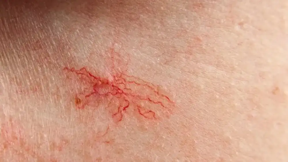 Jak wygląda cera naczynkowa? Objawy, cechy i skuteczne porady