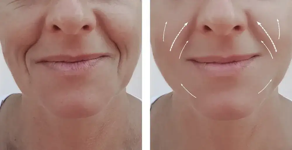 Bruzdy nosowo-wargowe: Botox czy kwas hialuronowy - co wybrać?