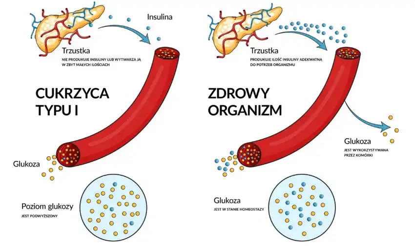 Skąd się bierze cukrzyca? Poznaj zaskakujące przyczyny i czynniki ryzyka