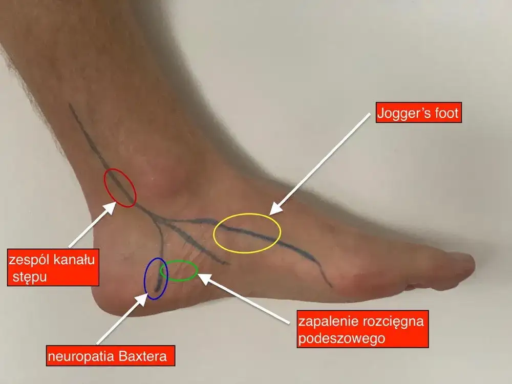 Ból pięty u biegacza jak go pokonać i biegać bez kontuzji?