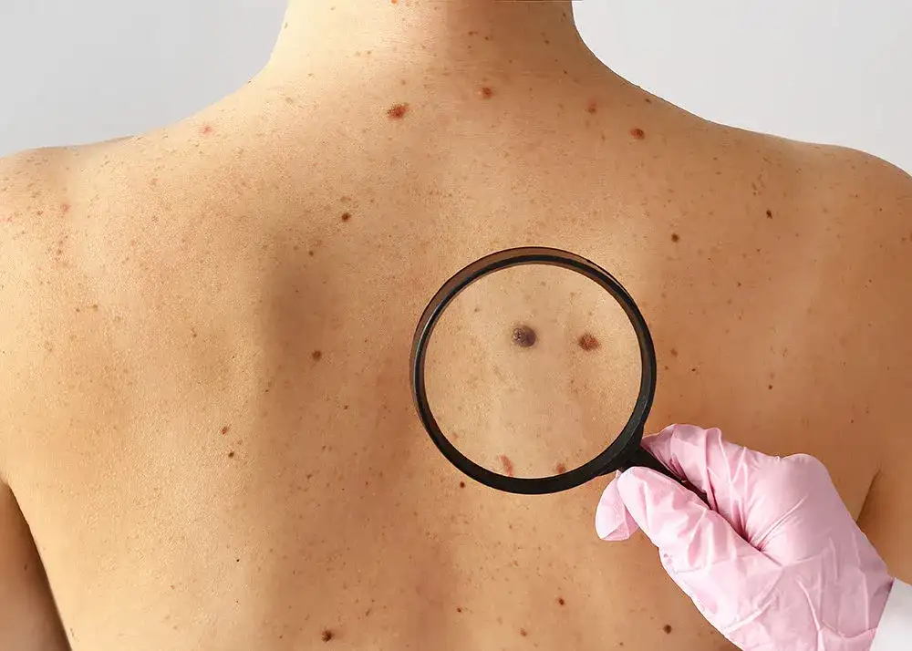 Pieprzyk boli jak pryszcz – co to oznacza i kiedy iść do lekarza