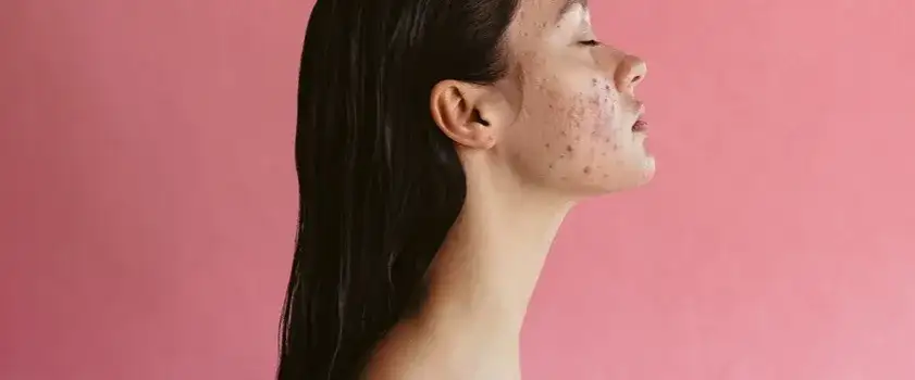 Jak uratować skórę po wyciśnięciu pryszcza? Szybkie kroki i porady!