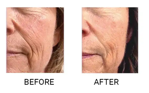 Endermologia twarzy: Naturalny lifting bez skalpela. Efekty, cena.