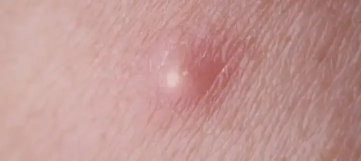 Pryszcze w miejscach intymnych - co je powoduje i kiedy się martwić