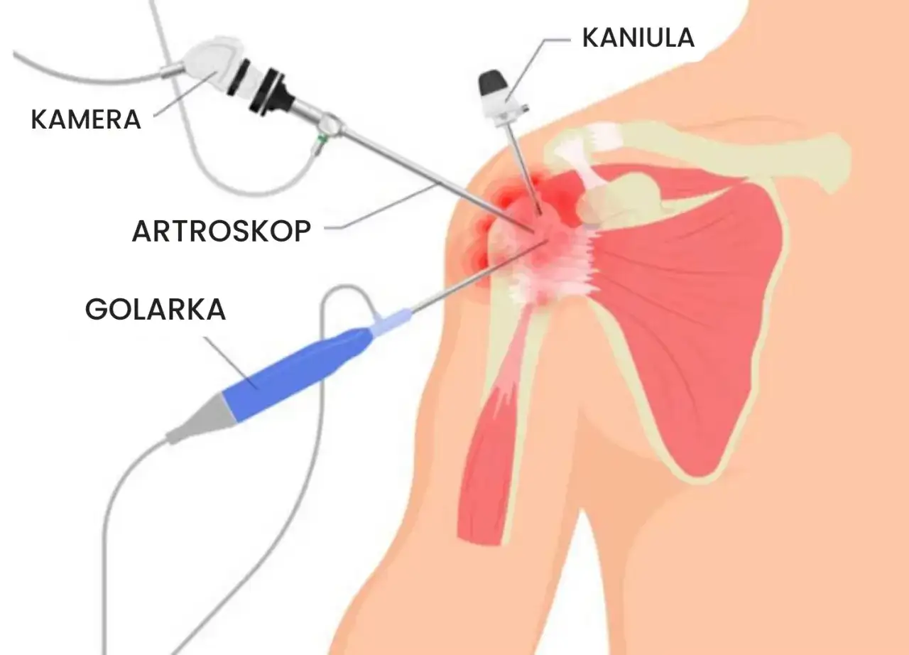 Ilustracja przedstawia artroskopię barku: kamerę, artroskop, golarkę i kaniulę w stawie.