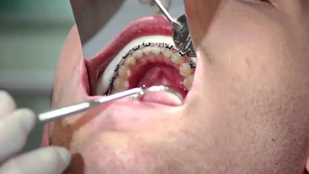 Jak włożyć drut do aparatu? Bezpieczna instrukcja krok po kroku