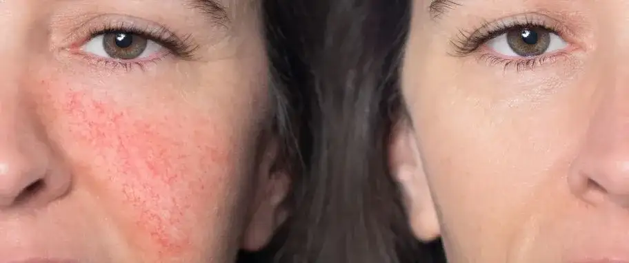 Jaki krem do cery naczynkowej, aby skutecznie wzmocnić naczynia?