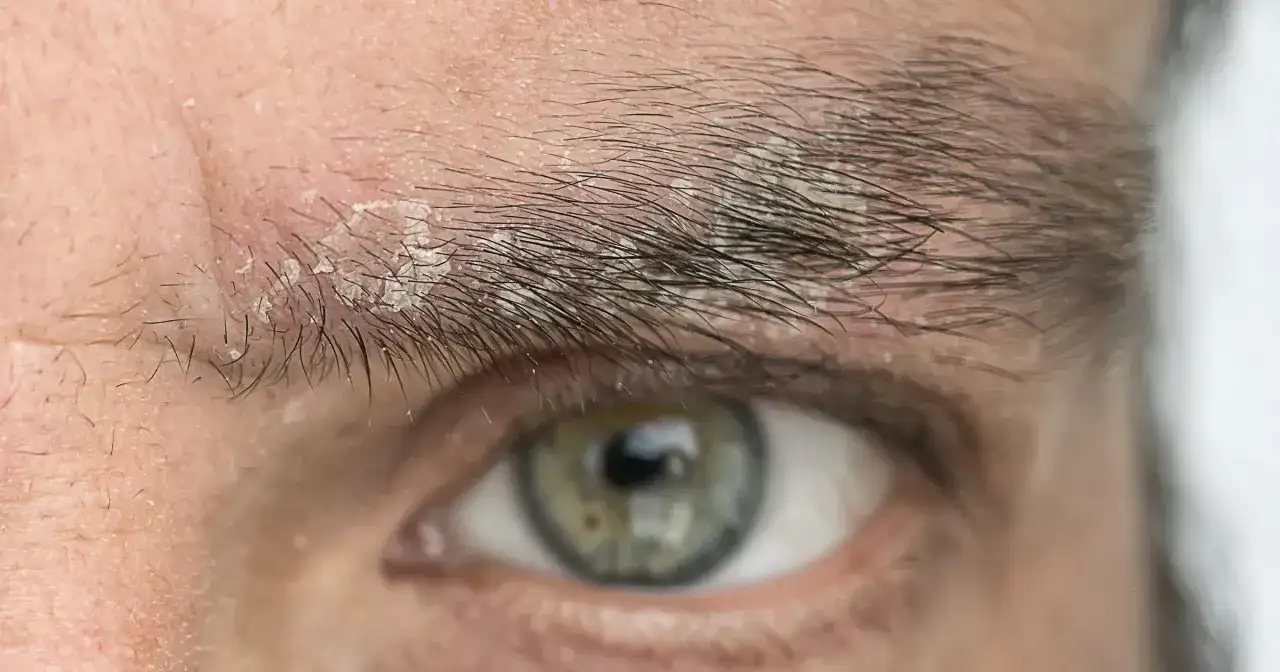 Pryszcz między brwiami: Szybkie sposoby na pozbycie się i zapobieganie