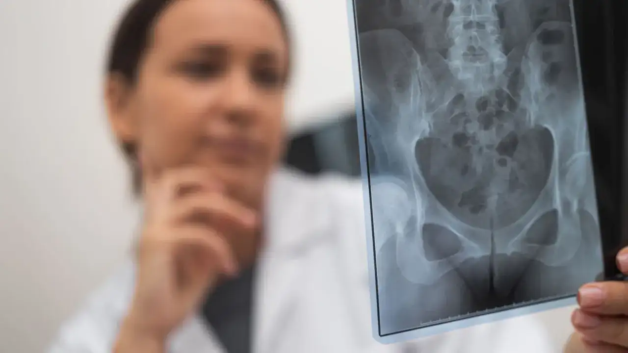 Złamane biodro: 5 kluczowych objawów, które musisz znać