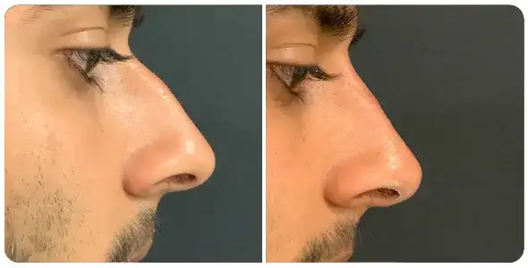 Rinomodelación con ácido hialurónico: mejora tu nariz sin cirugía