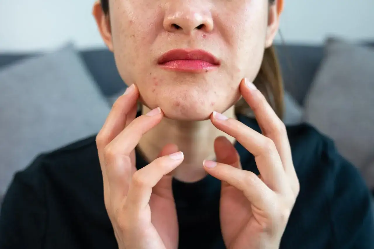 Rana po pryszczu? Zagój ją szybko domowymi metodami i uniknij blizn