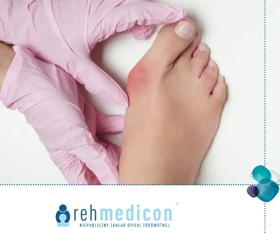 Zapalenie haluksa: Jak rozpoznać i szybko złagodzić ból?