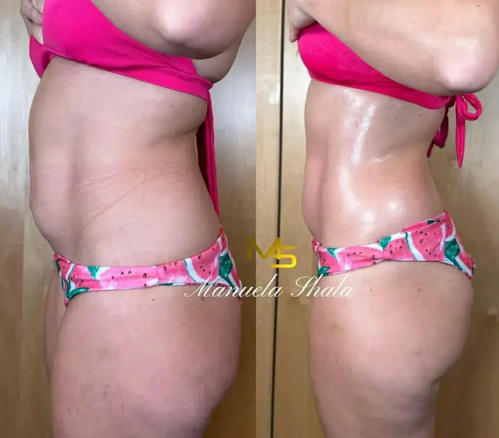 Drenaż limfatyczny: Jak wygląda zabieg krok po kroku? Poznaj efekty!