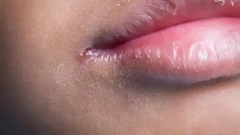 Die häufigsten Symptome bei Folsäuremangel: Warnzeichen erkennen