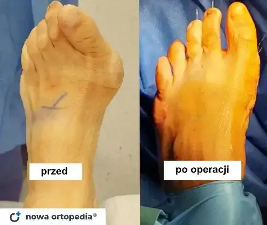 Operacja haluksa: czas zabiegu i pełna rekonwalescencja przewodnik