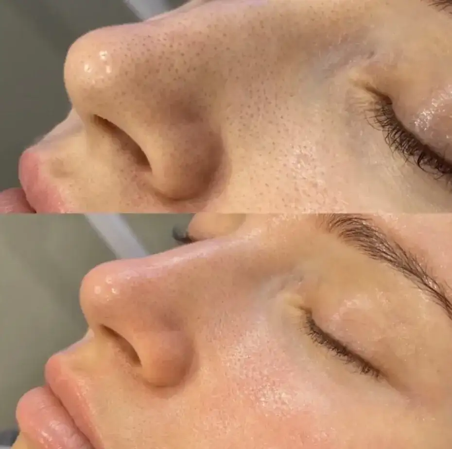 Mikrodermabrazja czy warto? Odkryj jej prawdziwe efekty i ryzyko