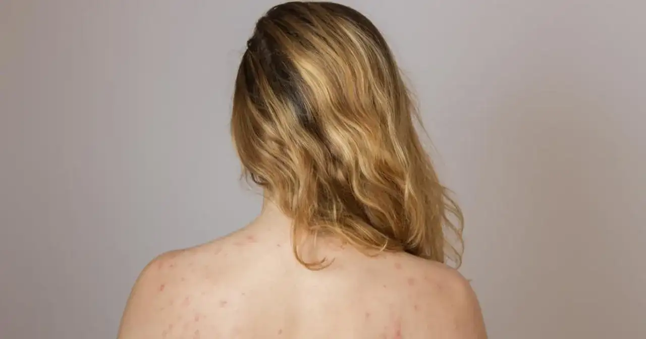 Pryszcze na plecach: Co je powoduje i jak skutecznie się ich pozbyć?