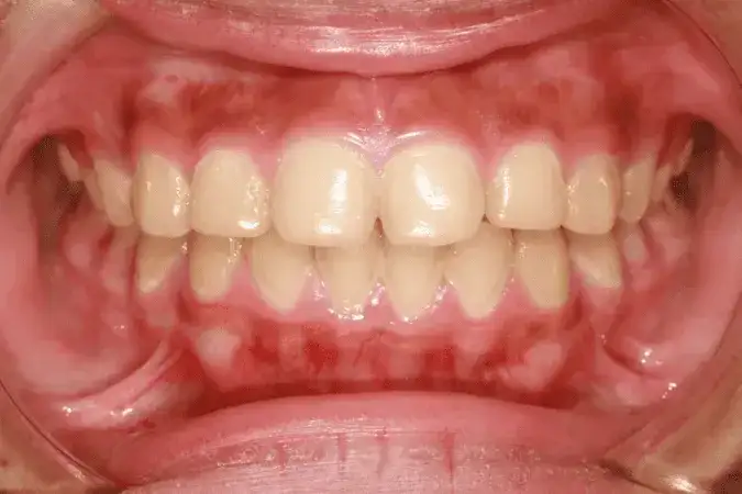 Czy zapalenie dziąseł jest zakaźne? Rozwiewamy mity i obawy!