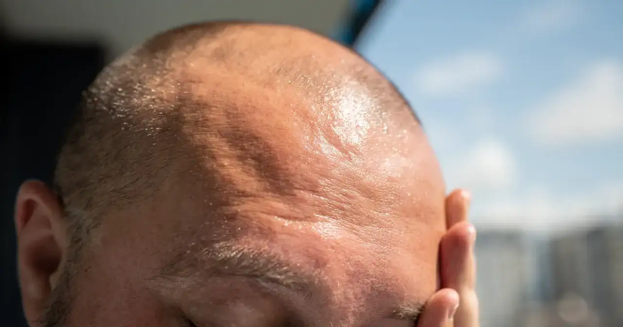 Ile utrzymują się objawy udaru słonecznego i jak przyspieszyć powrót do zdrowia