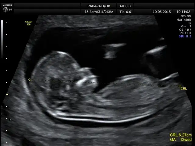 Płeć dziecka: Kiedy i jak ją poznać? NIPT (10 tyg.), USG poradnik