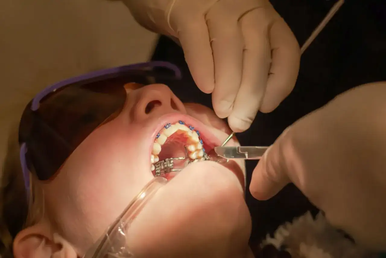 Zakładanie aparatu na zęby: Ile trwa i czego się spodziewać?