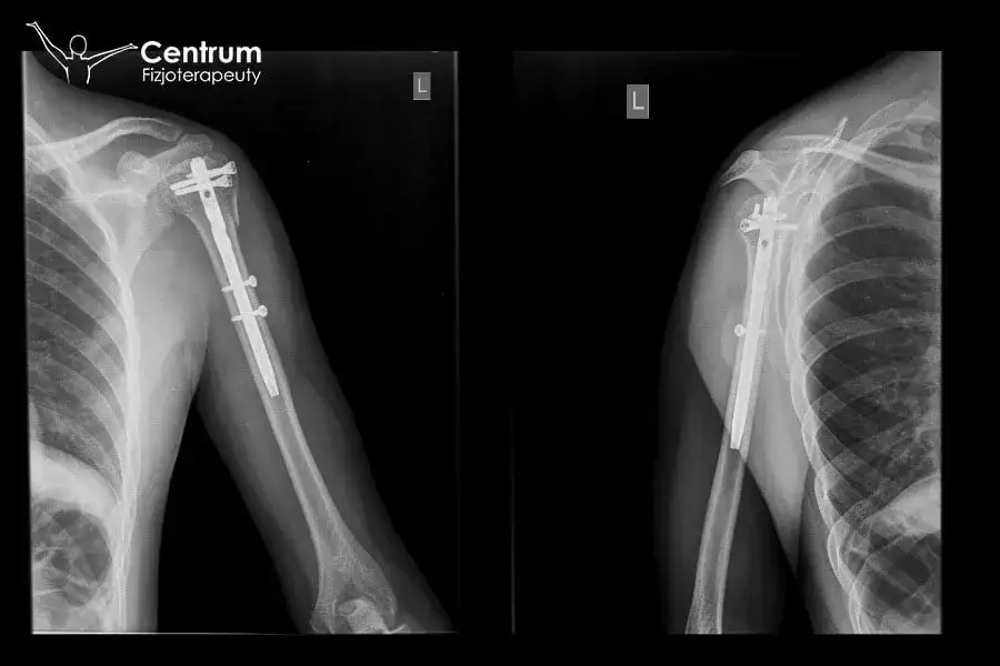 Złamanie kości ramiennej: rehabilitacja krok po kroku. Ile trwa?